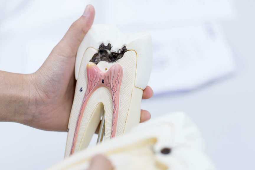 Dummy Model Of A Tooth Cavity