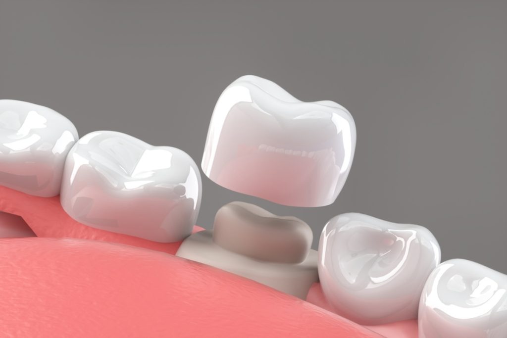 dental crowns ne calgary