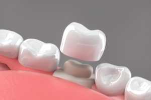 dental crowns ne calgary