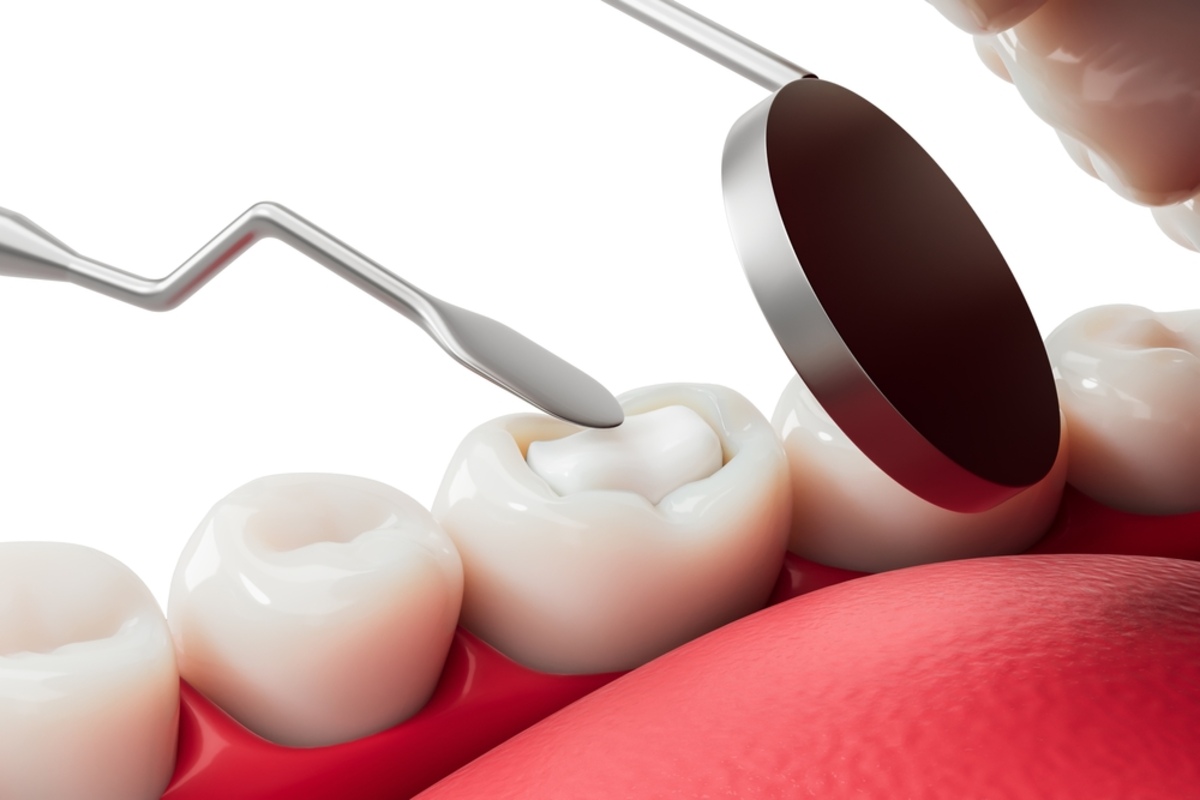 dental fillings ne calgary