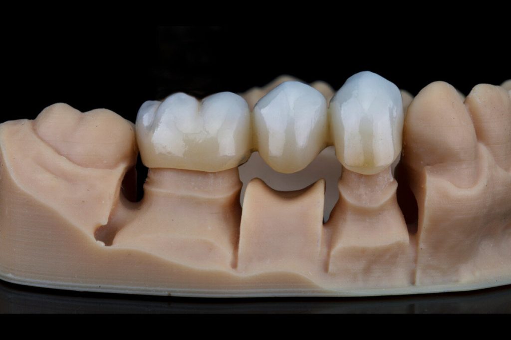 dental bridges ne calgary